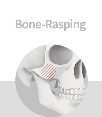 Bone-Rasping